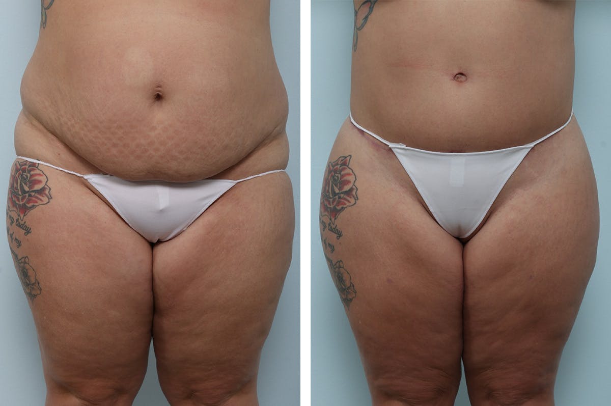 Body Lift Before & After Gallery - Patient 55982169 - Image 1