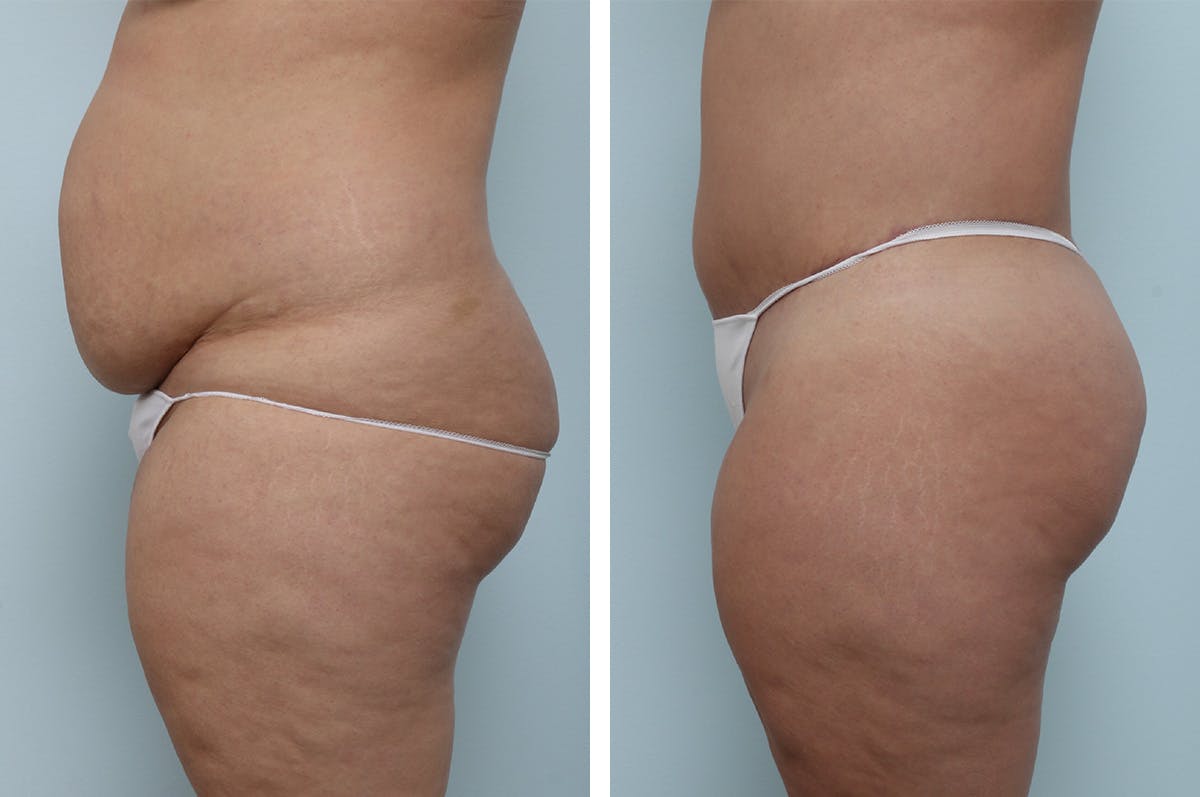 Body Lift Before & After Gallery - Patient 55982169 - Image 2