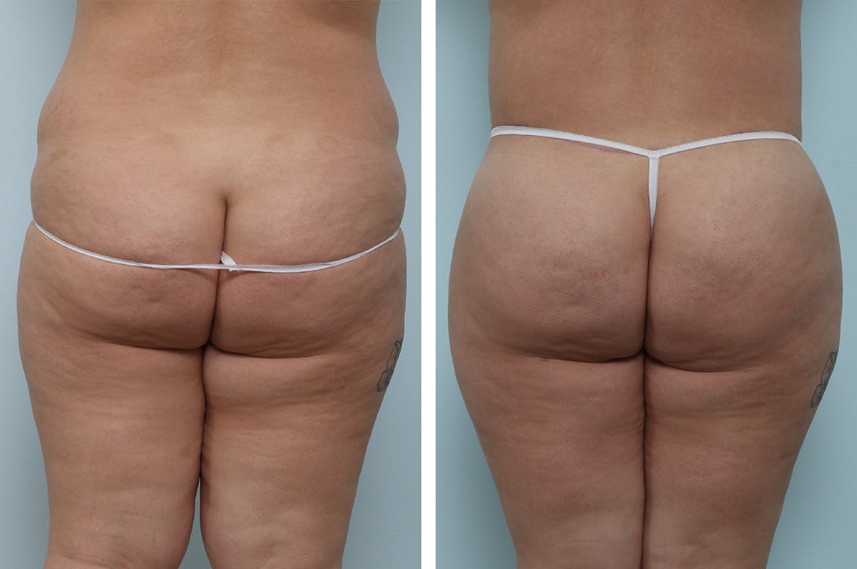 Body Lift Before & After Gallery - Patient 55982169 - Image 3