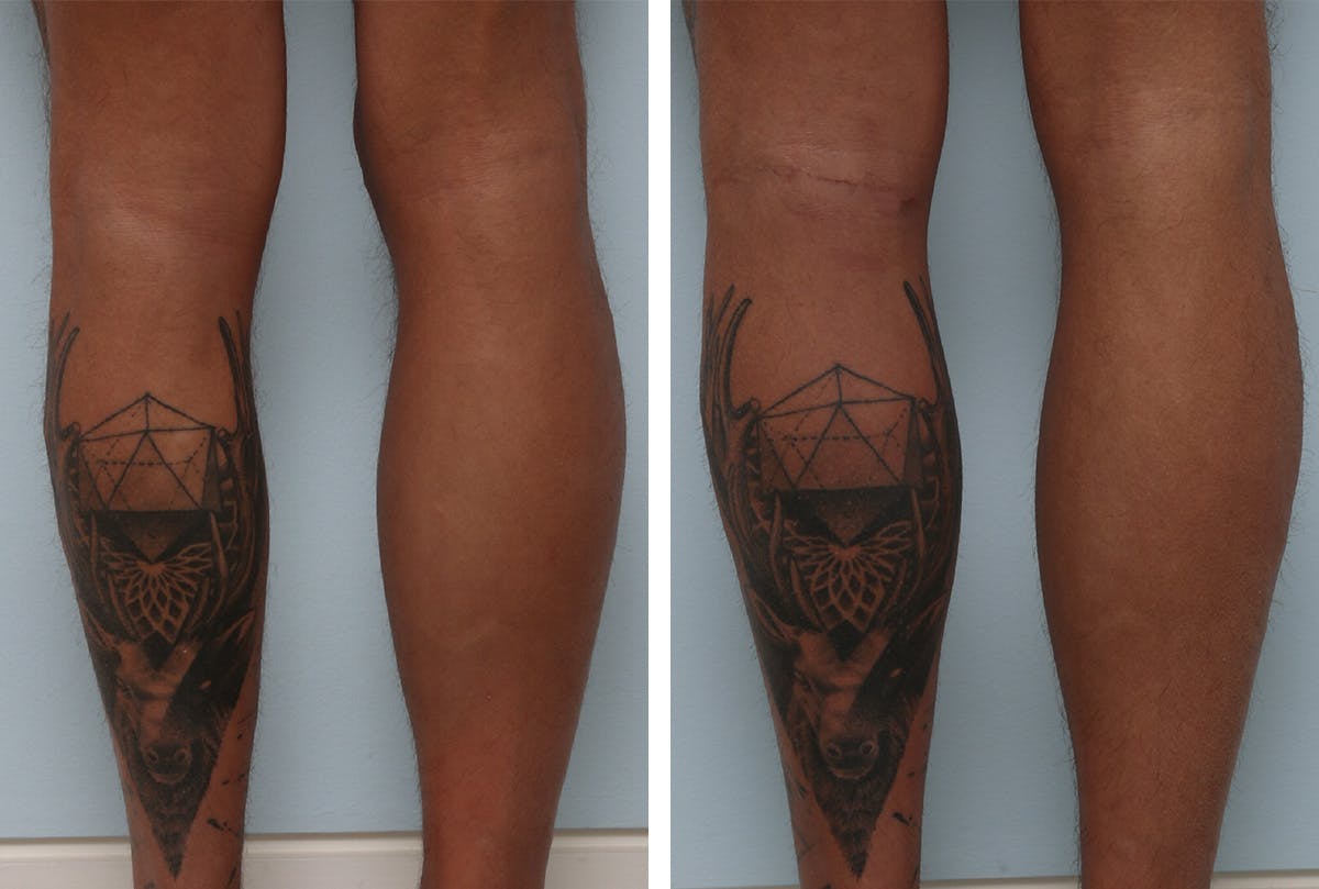 Calf Implants Before & After Gallery - Patient 55982176 - Image 2