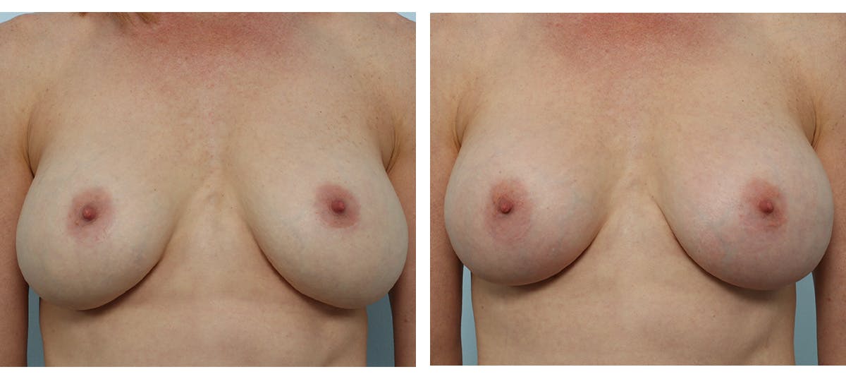 Breast Implant Exchange Before & After Gallery - Patient 55982180 - Image 1