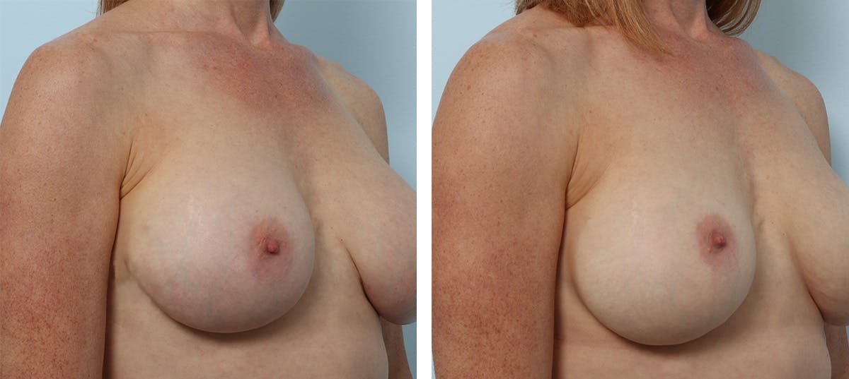 Breast Implant Exchange Before & After Gallery - Patient 55982180 - Image 2