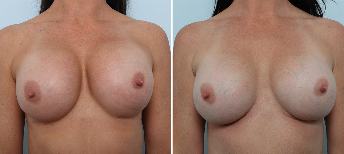 Breast Revision with Strattice Before & After Gallery - Patient 55982182 - Image 1