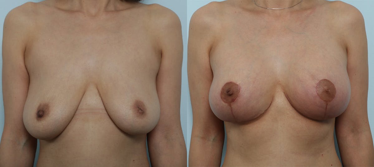 Breast Augmentation-Mastopexy Before & After Gallery - Patient 55986604 - Image 1