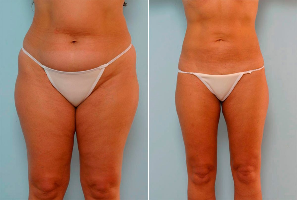 , Before and After Photos Liposuction Before and After Photos in Houston, TX, Patient 29161