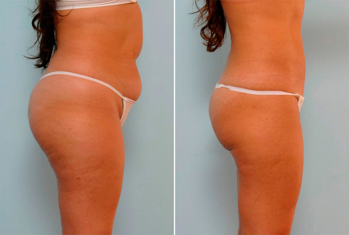 , Before and After Photos Liposuction Before and After Photos in Houston, TX, Patient 29161