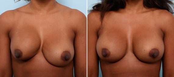 Breast Augmentation with Strattice Before and After Photos in Houston, TX, Patient 27202