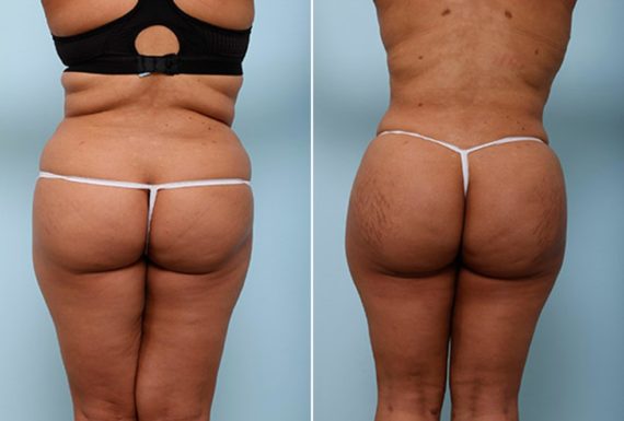 , Before and After Photos Butt Augmentation Before and After Photos in Houston, TX, Patient 27935