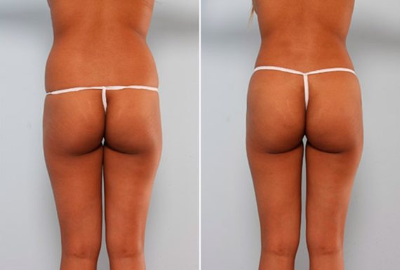 Butt Augmentation Before and After Photos in Houston, TX, Patient 27928