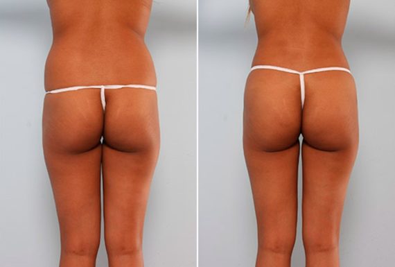 , Before and After Photos Butt Augmentation Before and After Photos in Houston, TX, Patient 27928