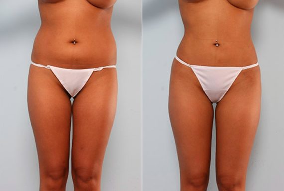 , Before and After Photos Butt Augmentation Before and After Photos in Houston, TX, Patient 27928