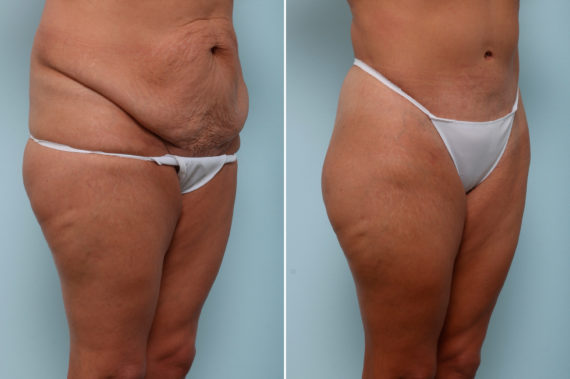 Body Lift Before and After Photos in Houston, TX, Patient 59897