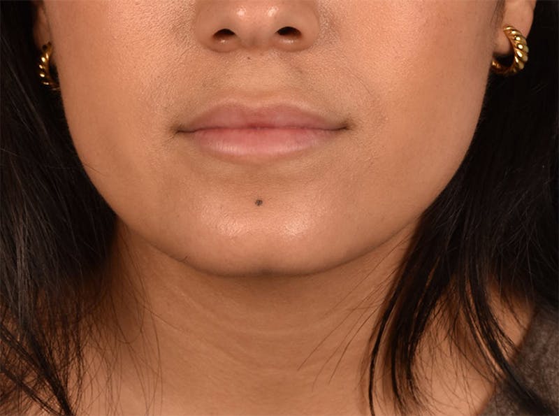 Injectables Before & After Gallery - Patient 51538654 - Image 1