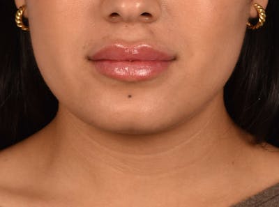 Injectables Before & After Gallery - Patient 51538654 - Image 2