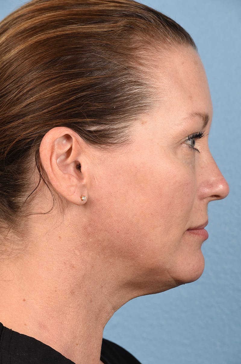 Injectables Before & After Gallery - Patient 51538657 - Image 7