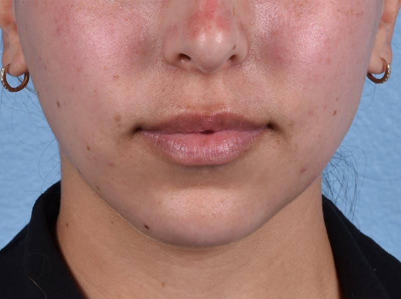 Injectables Before & After Gallery - Patient 51538658 - Image 1
