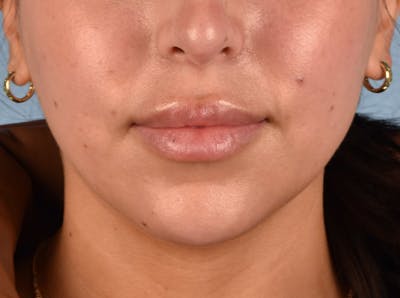 Injectables Before & After Gallery - Patient 51538658 - Image 2