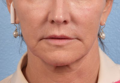 Thread Lifting Before & After Gallery - Patient 51538670 - Image 1
