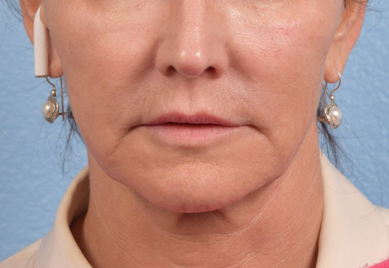 Thread Lifting Before & After Gallery - Patient 51538670 - Image 1