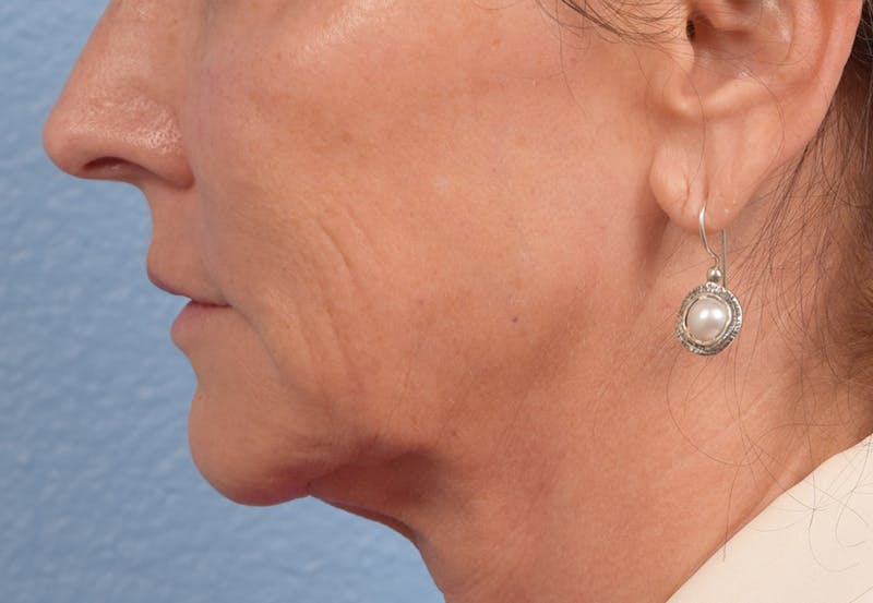Thread Lifting Before & After Gallery - Patient 51538670 - Image 3