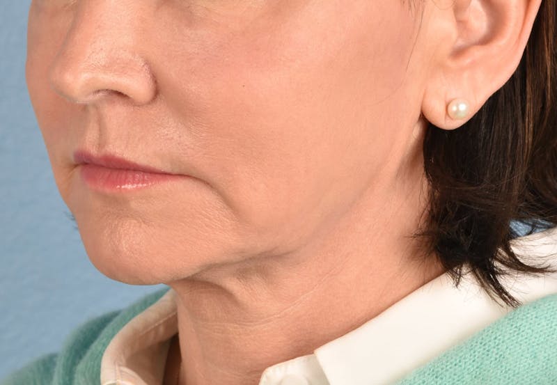 Thread Lifting Before & After Gallery - Patient 51538670 - Image 6