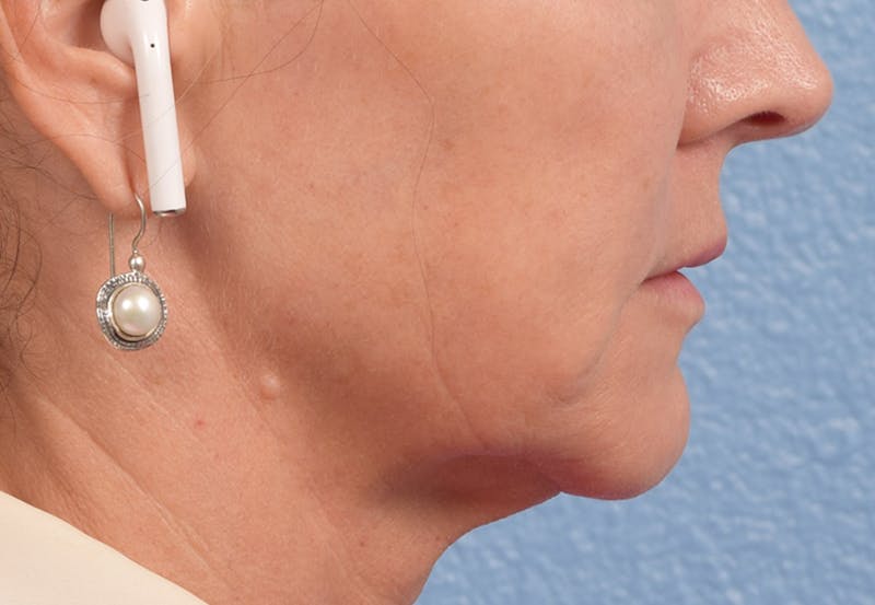 Thread Lifting Before & After Gallery - Patient 51538670 - Image 7