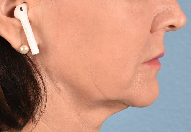 Thread Lifting Before & After Gallery - Patient 51538670 - Image 8