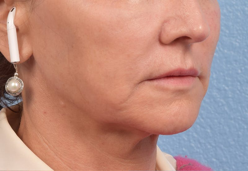 Thread Lifting Before & After Gallery - Patient 51538670 - Image 9