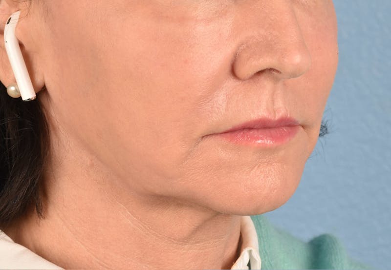 Thread Lifting Before & After Gallery - Patient 51538670 - Image 10