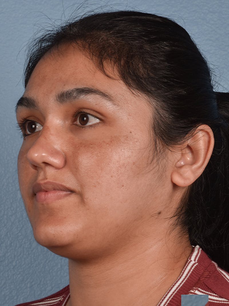 Piqo4 Laser Before & After Gallery - Patient 51538672 - Image 3