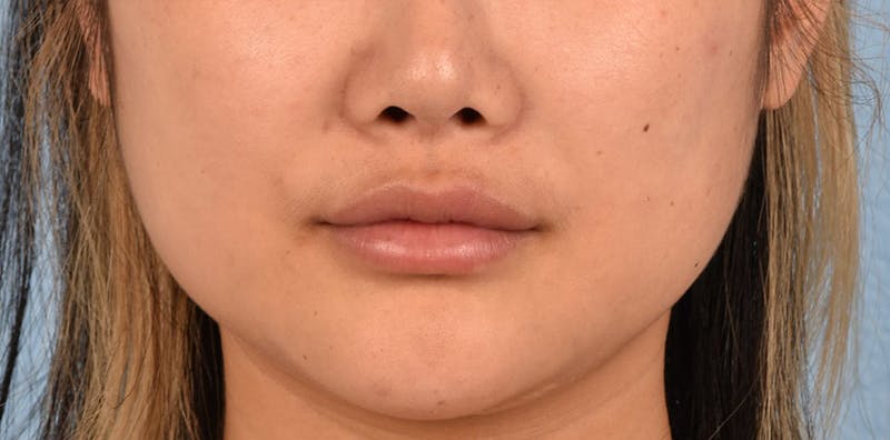 Thread Lifting Before & After Gallery - Patient 51538677 - Image 1