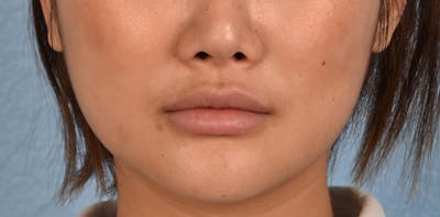 Thread Lifting Before & After Gallery - Patient 51538677 - Image 2