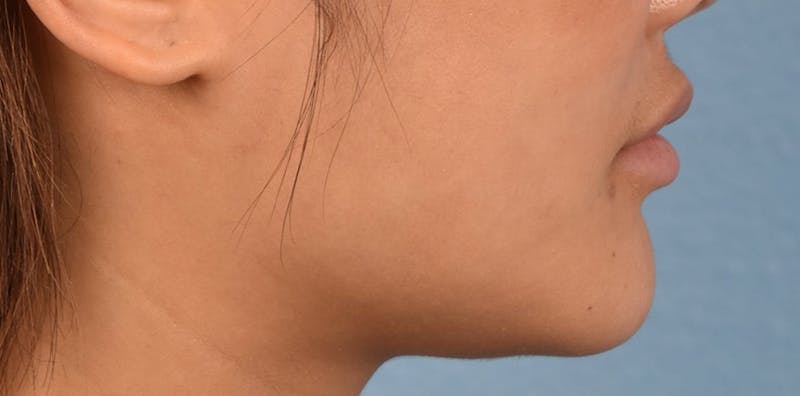 Thread Lifting Before & After Gallery - Patient 51538677 - Image 4