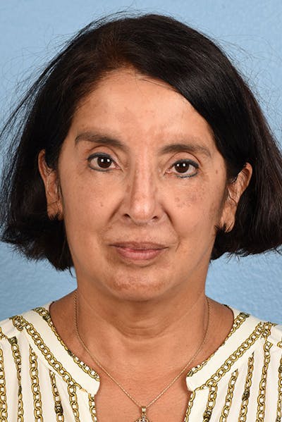 Piqo4 Laser Before & After Gallery - Patient 51538675 - Image 2