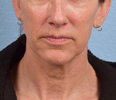 Thread Lifting Before & After Gallery - Patient 51538678 - Image 1