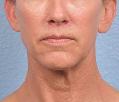 Thread Lifting Before & After Gallery - Patient 51538678 - Image 2