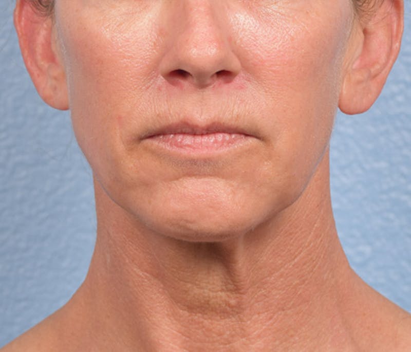 Thread Lifting Before & After Gallery - Patient 51538678 - Image 2