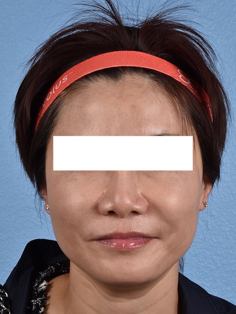 Thread Lifting Before & After Gallery - Patient 51538683 - Image 1