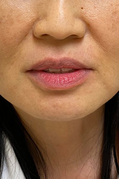Injectables Before & After Gallery - Patient 51538681 - Image 1