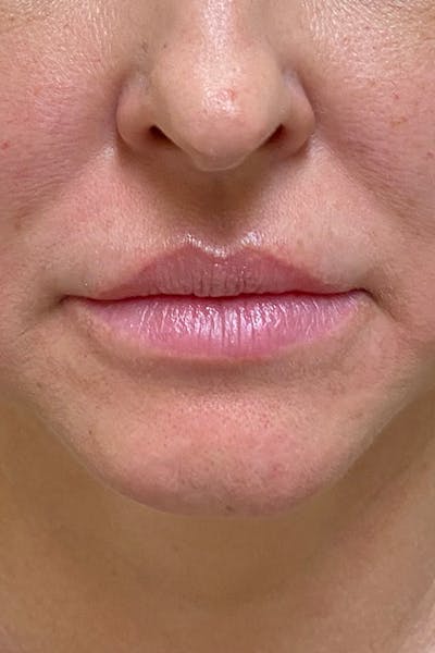 Injectables Before & After Gallery - Patient 51538685 - Image 1