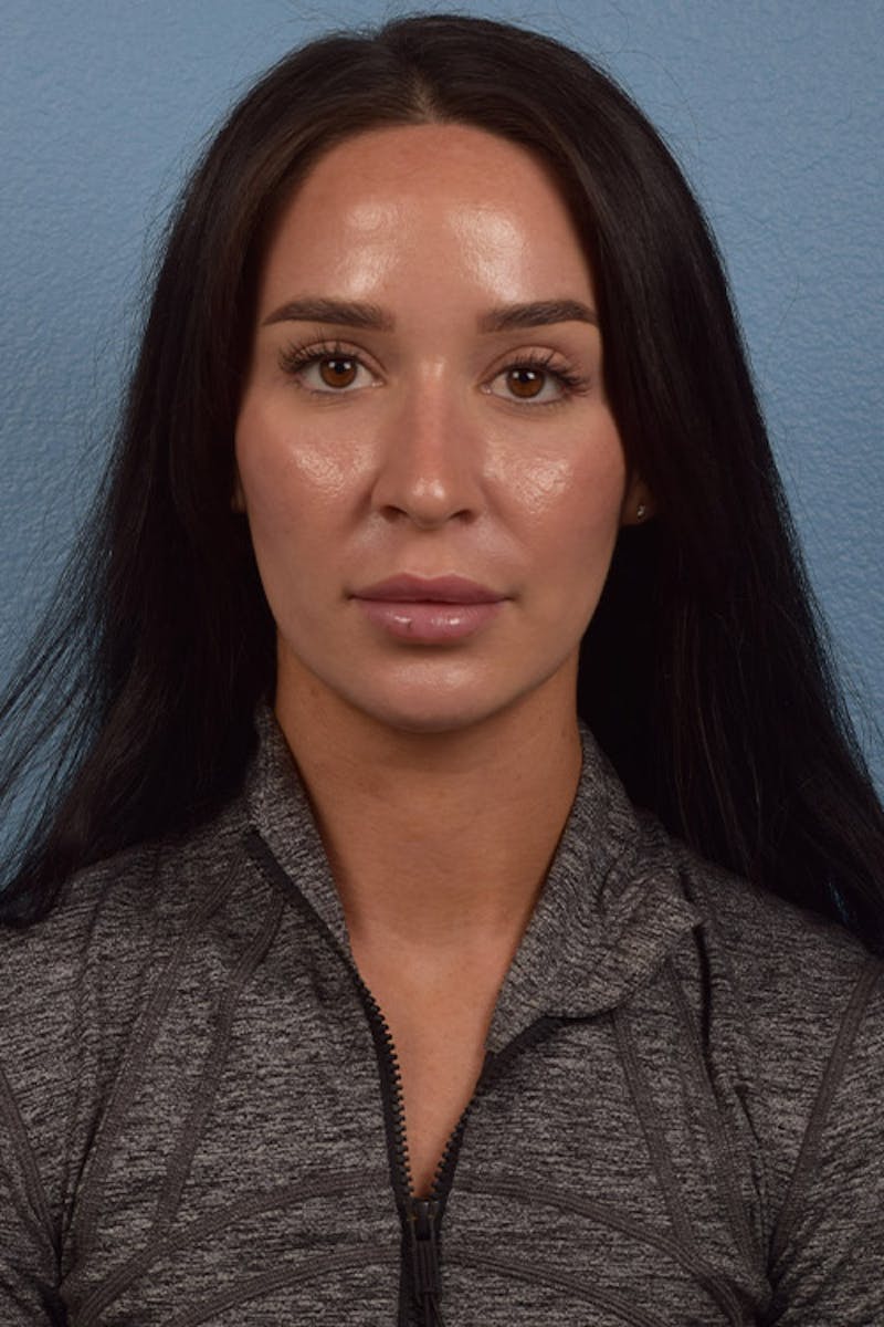 Wrinkle Relaxers Before & After Gallery - Patient 51538688 - Image 2