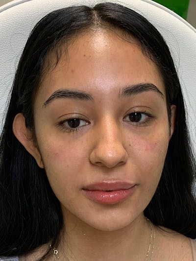 Lip Fillers Before & After Gallery - Patient 51538692 - Image 2