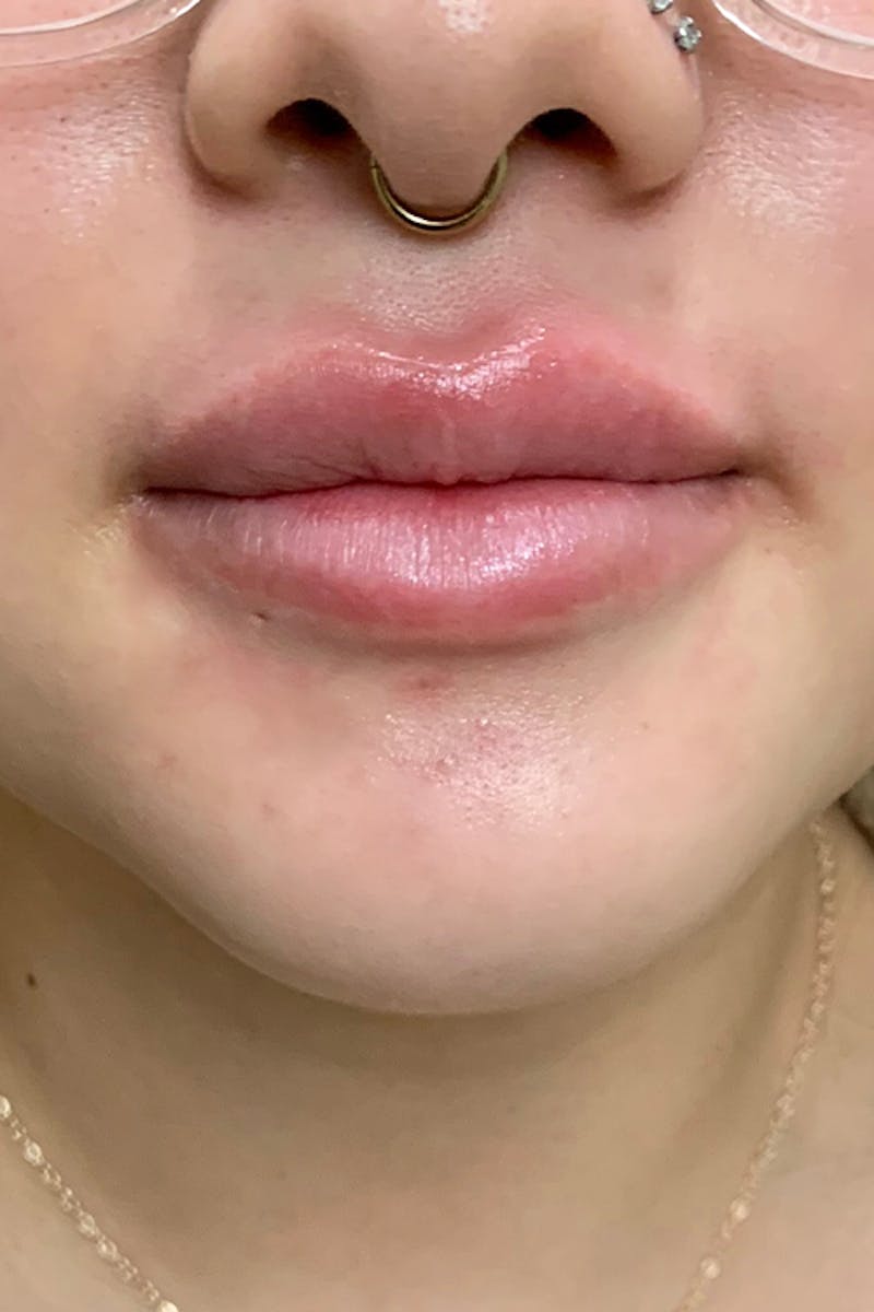 Lip Fillers Before & After Gallery - Patient 51538694 - Image 1