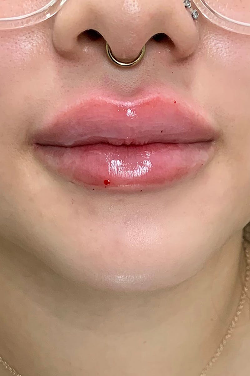 Lip Fillers Before & After Gallery - Patient 51538694 - Image 2