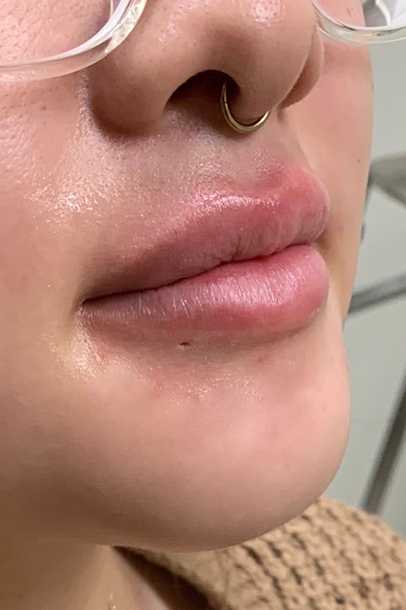 Lip Fillers Before & After Gallery - Patient 51538694 - Image 3
