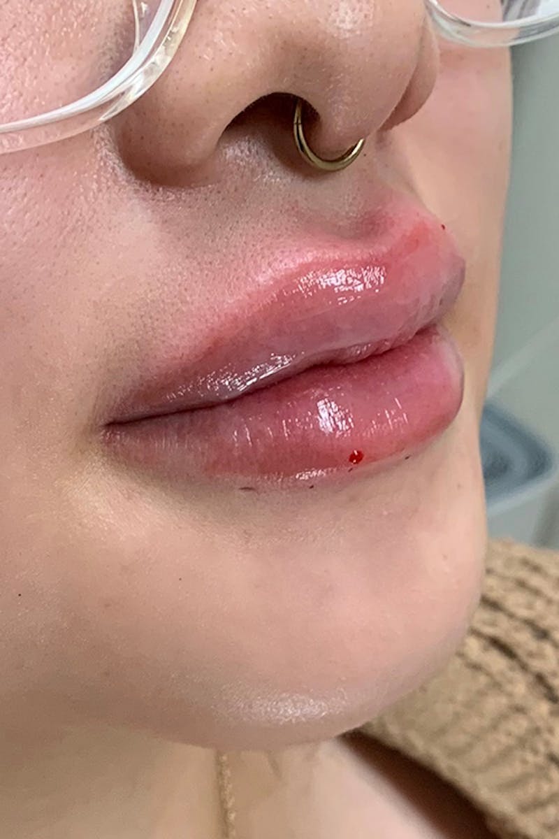 Lip Fillers Before & After Gallery - Patient 51538694 - Image 4