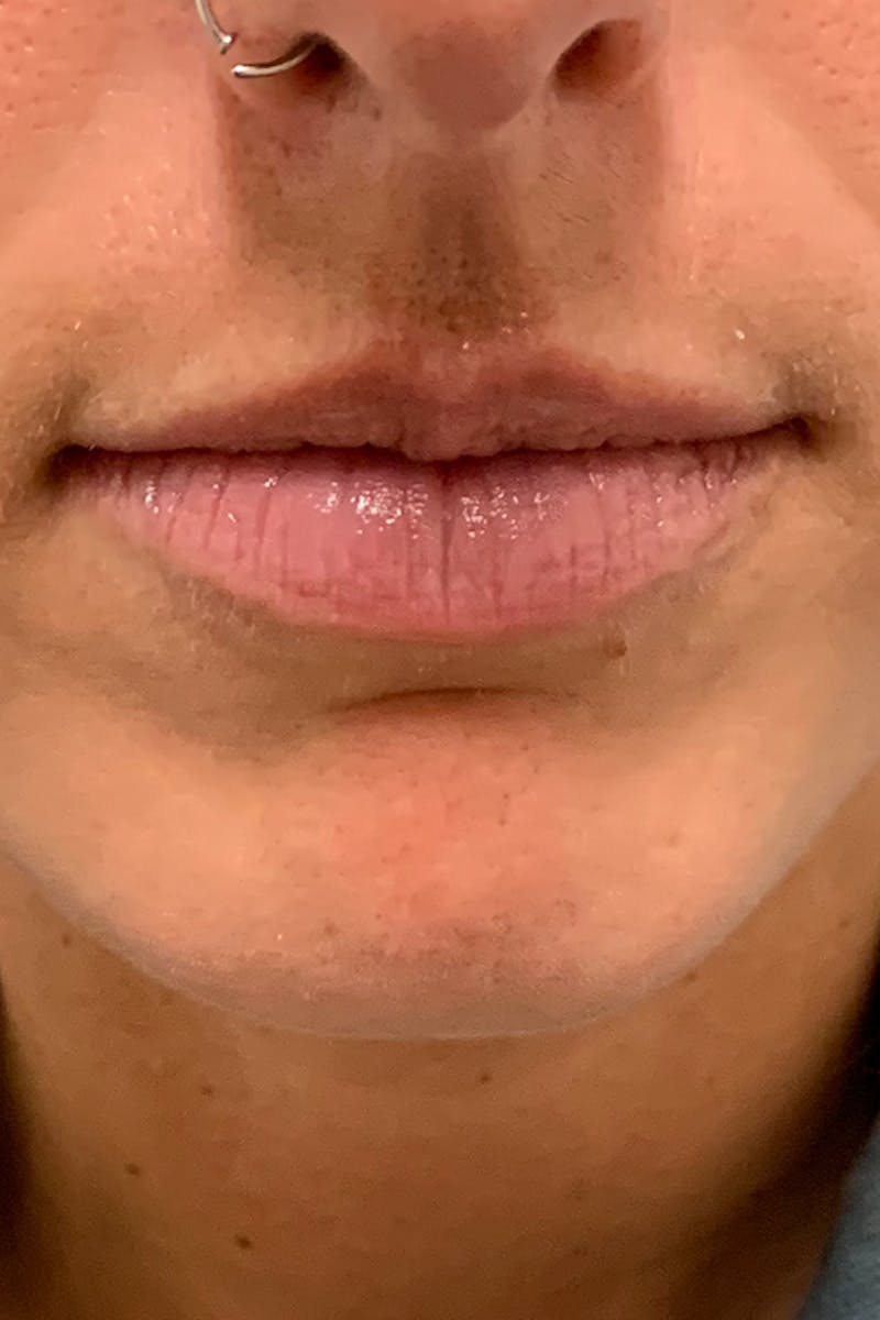 Lip Fillers Before & After Gallery - Patient 51538700 - Image 1