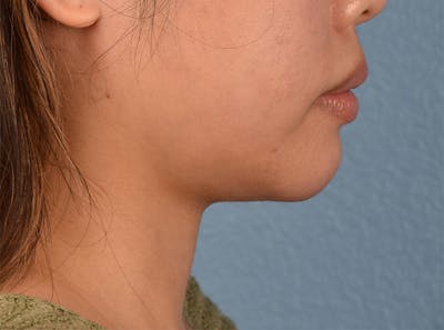 Facial Fillers Before & After Gallery - Patient 51538698 - Image 1