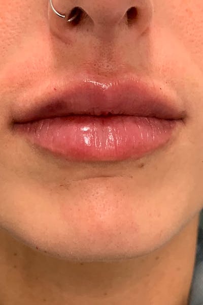 Lip Fillers Before & After Gallery - Patient 51538700 - Image 2