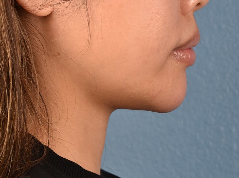 Facial Fillers Before & After Gallery - Patient 51538698 - Image 2